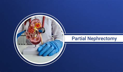 Everything To Know About Partial Nephrectomy