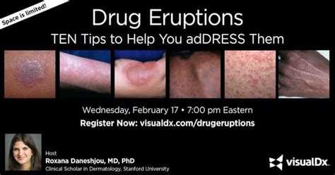 Drug Eruptions Ten Tips To Help You Address Them Visualdx