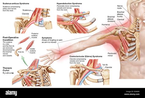Medizinische Illustration Detaillierung Thoracic Outlet Syndrom