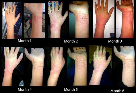 Scratching The Surface Of Topical Steroid Withdrawal Months 1 6