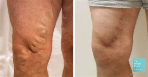 Varicose Vein Surgery Recovery Time Varicose Veins Treatment Before