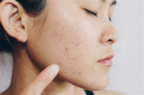 Effective Ways To Remove Acne Scars Facial Care Centre