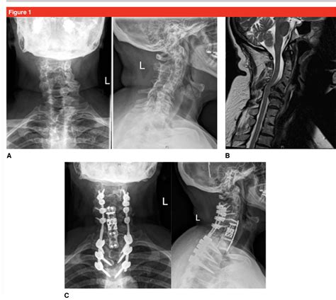 Figure 1 From Cervical Spine Deformity Indications Considerations