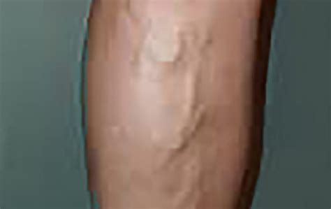 Varicose Veins Are More Than Just A Cosmetic Concern San Diego