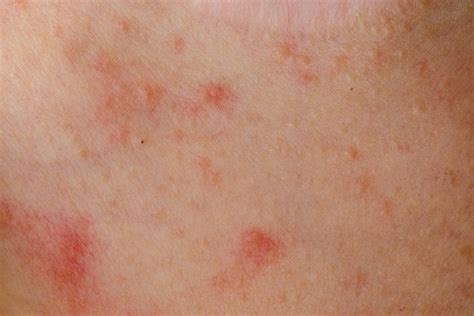 Dermatite Atópica Opções De Tratamento Caseiro E Médico Tua Saúde