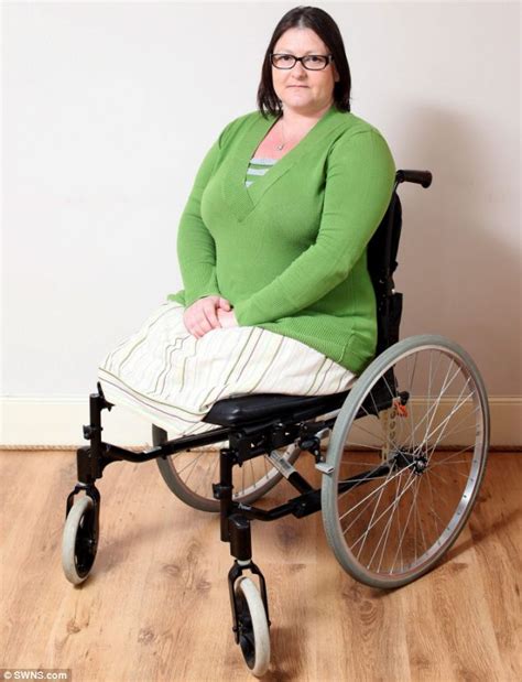 Buergers Disease Sufferer Lost Her Legs Because Of Smoking Daily