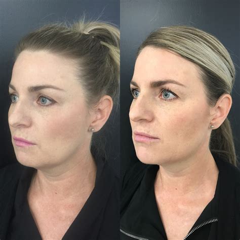 Non Surgical Jowl Lift Thread Lift HIFU Injectables Fillers For Jowl