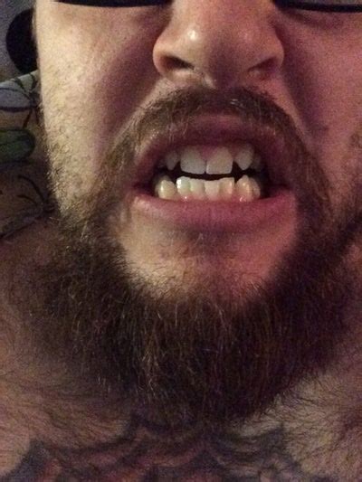 Maybe you would like to learn more about one of these? I have large front and canine teeth, and I am missing my ...