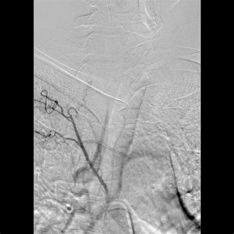 Spinal Arteriovenous Fistula Image