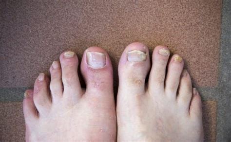 Mycose des pieds les traitements efficaces pour en venir à bout Nail