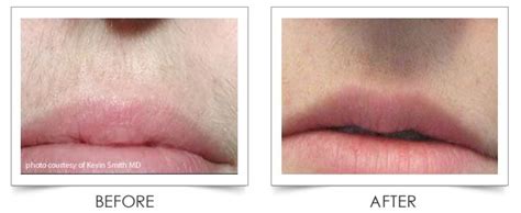 Laser Hair Removal Before And After Upper Lip