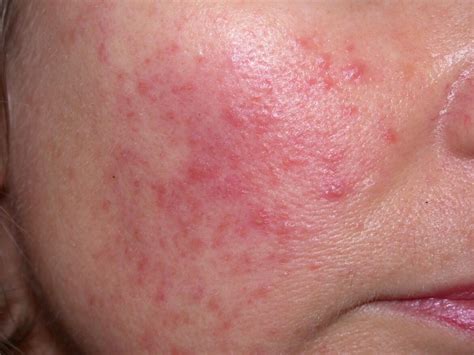 Itch Or Non Itchy Red Face Rash Causes And Treatments American Celiac