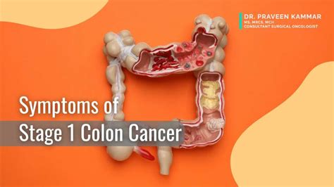 Know Symptoms Of Stage 1 Colon Cancer For Early Prevention