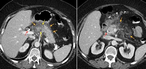 Prostate Cancer Ct Scan With Contrast Acute Pancreatitis Radiology