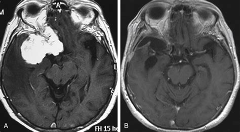Surgical Management Of Sphenoid Wing Meningiomas Clinical Gate