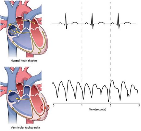 Ventricular Fibrillation Causes Symptoms Diagnosis Treatment And Prognosis