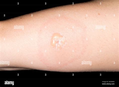 Insect Bite Allergy Skin Blisters On The Arm Of A 32 Year Old Woman
