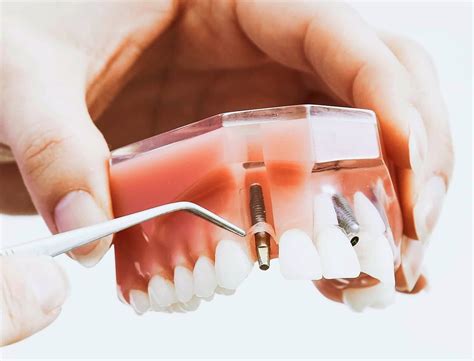 Implante Dental Todo El Proceso Contado Paso A Paso