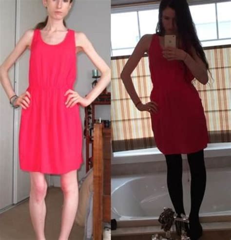Brave Anorexia Survivor Posts Shocking Recovery Photos On Weight Loss Thread