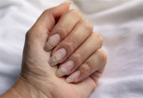 What It Means When You Have Peeling Nails And How To Fix Them Ekenyan