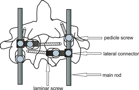 The Four Fixation Points Of The Axis Technique And Case Report