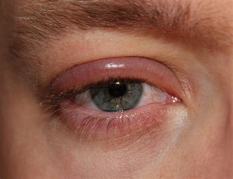 Eyelid Disorders Summary Geeky Medics