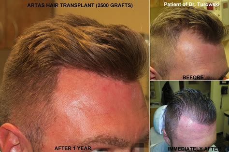 New Horizons Plastic Surgery Artas Hair Transplant 1 Year Result