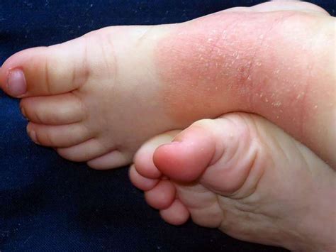 Psoriasis On Feet Symptoms Causes And Treatment Take The Health