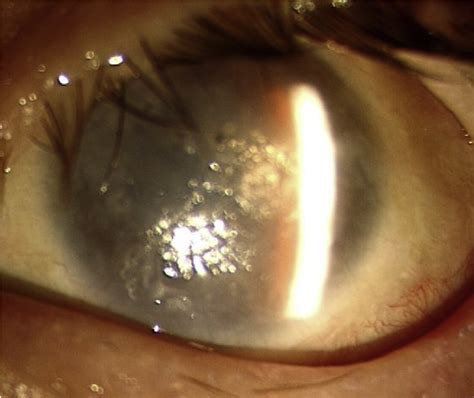 Figure 1 From Toxic Anterior Segment Syndrome A Sequel Of Uneventful Cataract Surgery