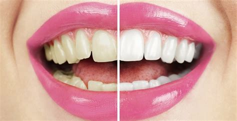 Teeth Whitening Procedures Healthlocal