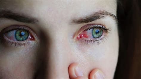 Pink Eye Conjunctivitis Symptoms Causes Treatments
