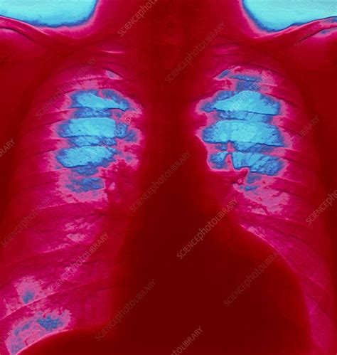 Coloured Chest X Ray Of Ventricular Cardiomyopathy Stock Image M172