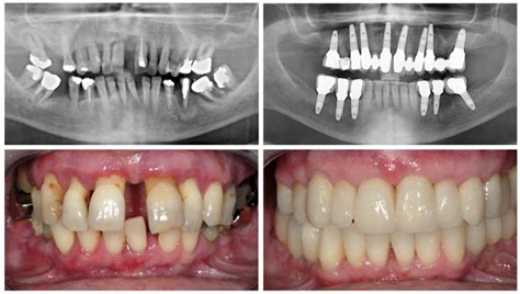 Treatment For Periodontal Disease Advanced Dentistry
