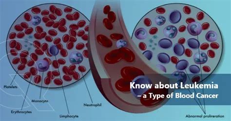 What You Must Know About Leukemia A Type Of Blood Cancer Oncquest