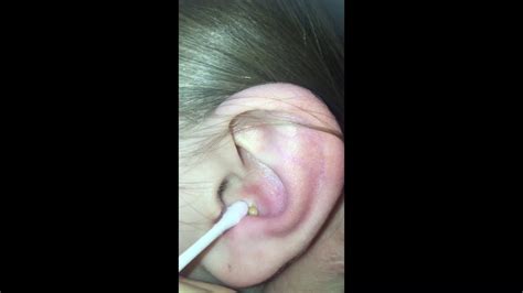Big Pimple Gets Popped Inside Ear With A Needle Youtube