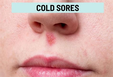 Cold Sore Vs Pimple Pictures And Differences