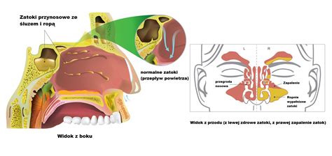 Zapalenie zatok jak leczyć i łagodzić dolegliwości Rinozine Rinozine