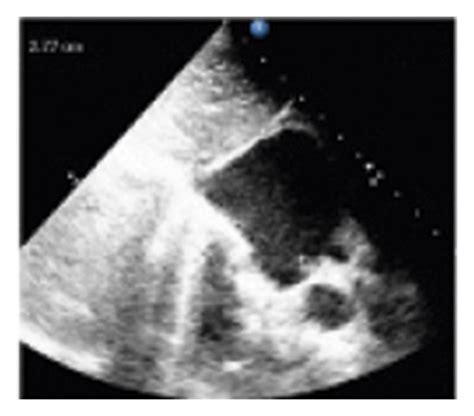 A Transthoracic Echocardiorgraghy Tte Imaging In Subcostal View