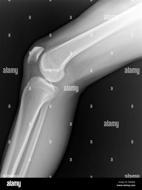 An X Ray Human Leg Knee Seen Side In Seated Position Femur Or
