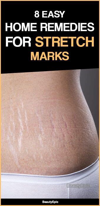 Pin By Tamara On Skin Care Diy In 2020 Stretch Mark Remedies Stretch