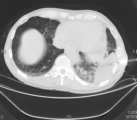 Organizing Pneumonia Ct Scan Case 246 A Photo On Flickriver