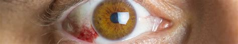 Subconjunctival Haemorrhage The Eye Practice