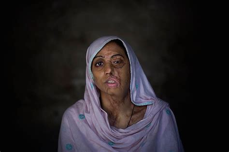These Women Are Tragically Scarred By Acid Attacks