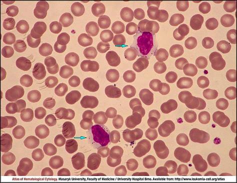 T Cell Large Granular Lymphocytic Leukaemia Cell Atlas Of