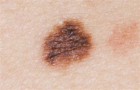 Atypical Mole Definition Causes Symptoms Diagnosis And Treatment