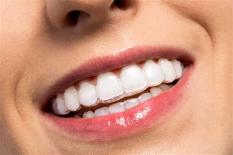 Secretly Improve Your Smile With Invisalign Belmar Orthodontics