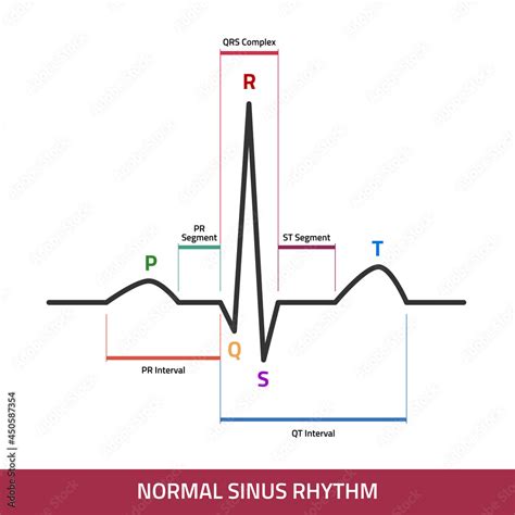 Ecg Of Normal Sinus Rhythm Infographic Diagram Showing Normal Heart Sexiezpix Web Porn