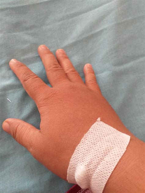 12+ Foto Tangan Di Infus Di Kamar