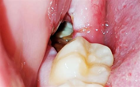 What Does Dry Socket Look Like After Wisdom Tooth Extraction