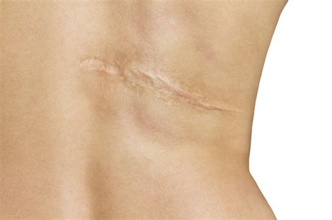 Scar After Operation On Back Of Women On White Background Mclean